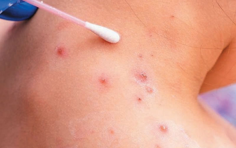 Autoridades uruguayas confirman el primer caso de viruela del mono en Salto