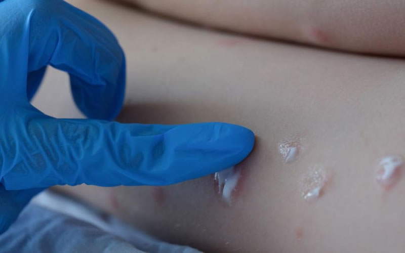 Corrientes detectó un caso de viruela del mono