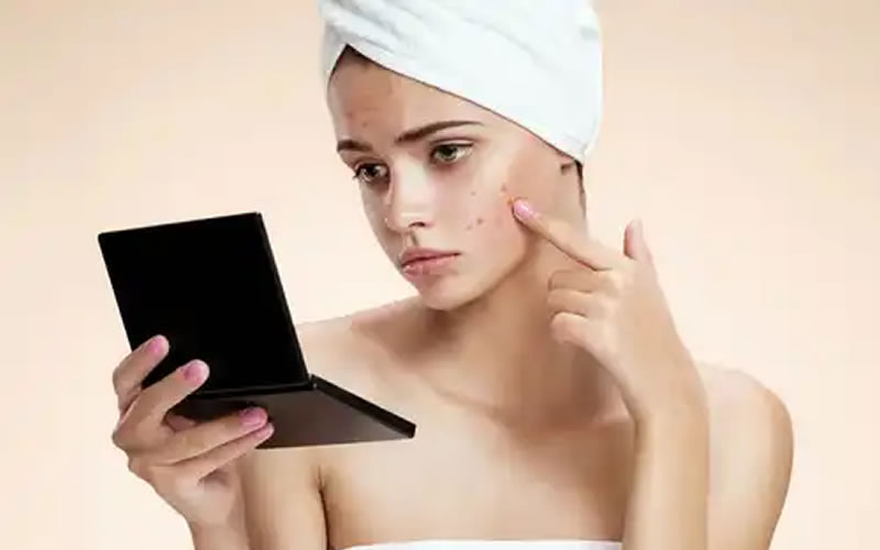 4 causas poco obvias de espinillas en el cuerpo que no están relacionadas con las hormonas