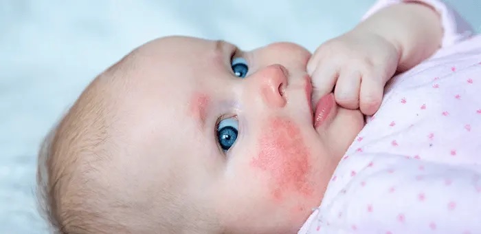 Los 5 tipos de irritaciones comunes en la piel del bebé