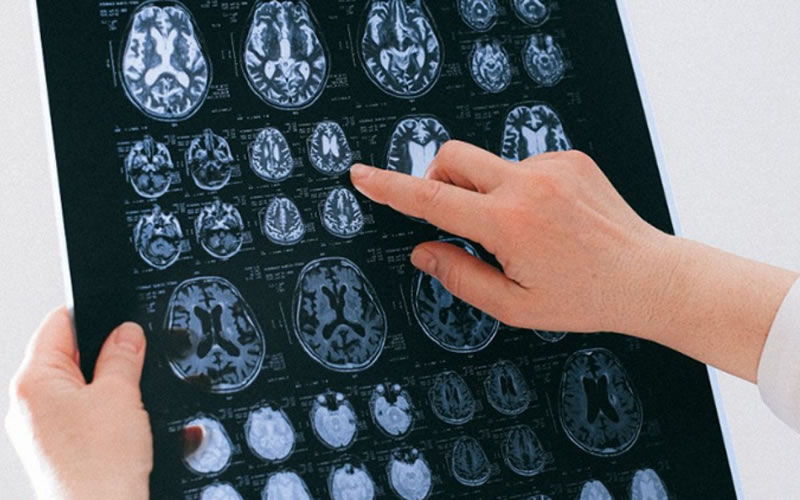Día Mundial de la Lucha contra el Accidente Cerebrovascular (ACV)