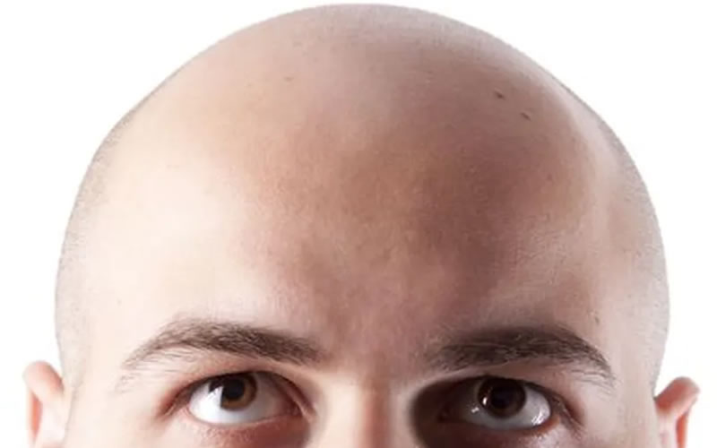 Día Mundial de los Calvos