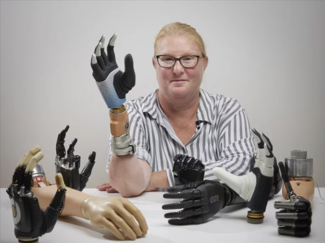 Innovación Histórica: una mano biónica se fucionó con el hueso y el sistema nervioso de una mujer amputada