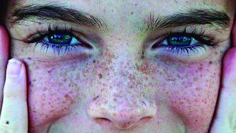 Las pecas en la piel: Su relación con la genética y la exposición al sol, todo lo que debes saber