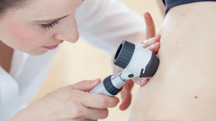 Alertan sobre el aumento de casos de cáncer de piel a partir de los 40 años: “Puede ser un lunar, pero también un aviso”
