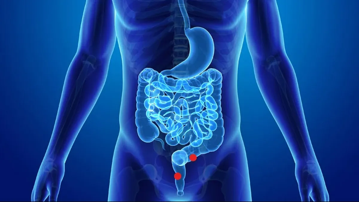 En Argentina se diagnostican casi 2 casos de cáncer de colon por día