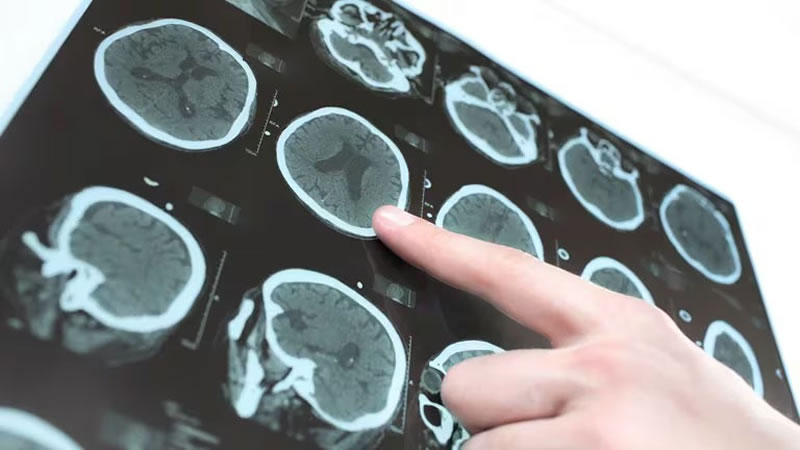 Avance contra el Parkinson: Científicos argentinos desarrollaron una molécula para tratarlo