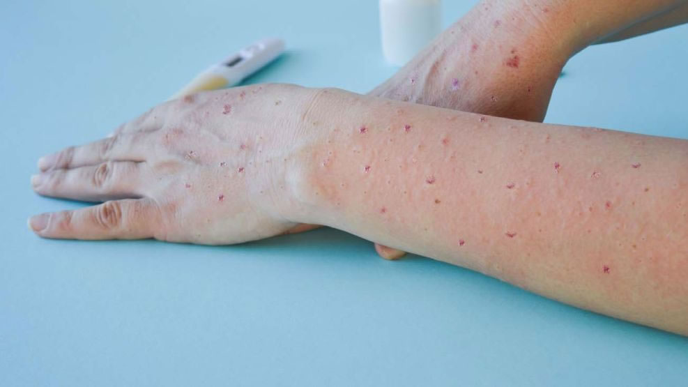 La OMS mantiene el alerta por la viruela del mono y lamenta la baja vacunación contra el covid