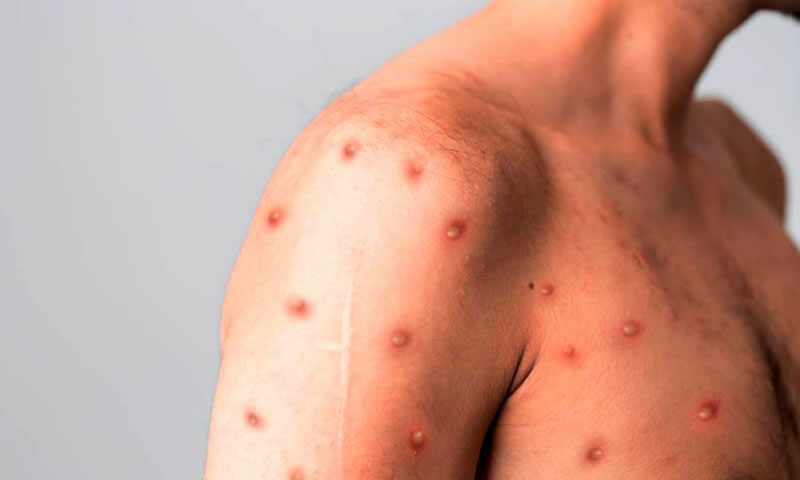 La OMS declaró la viruela del mono como emergencia internacional