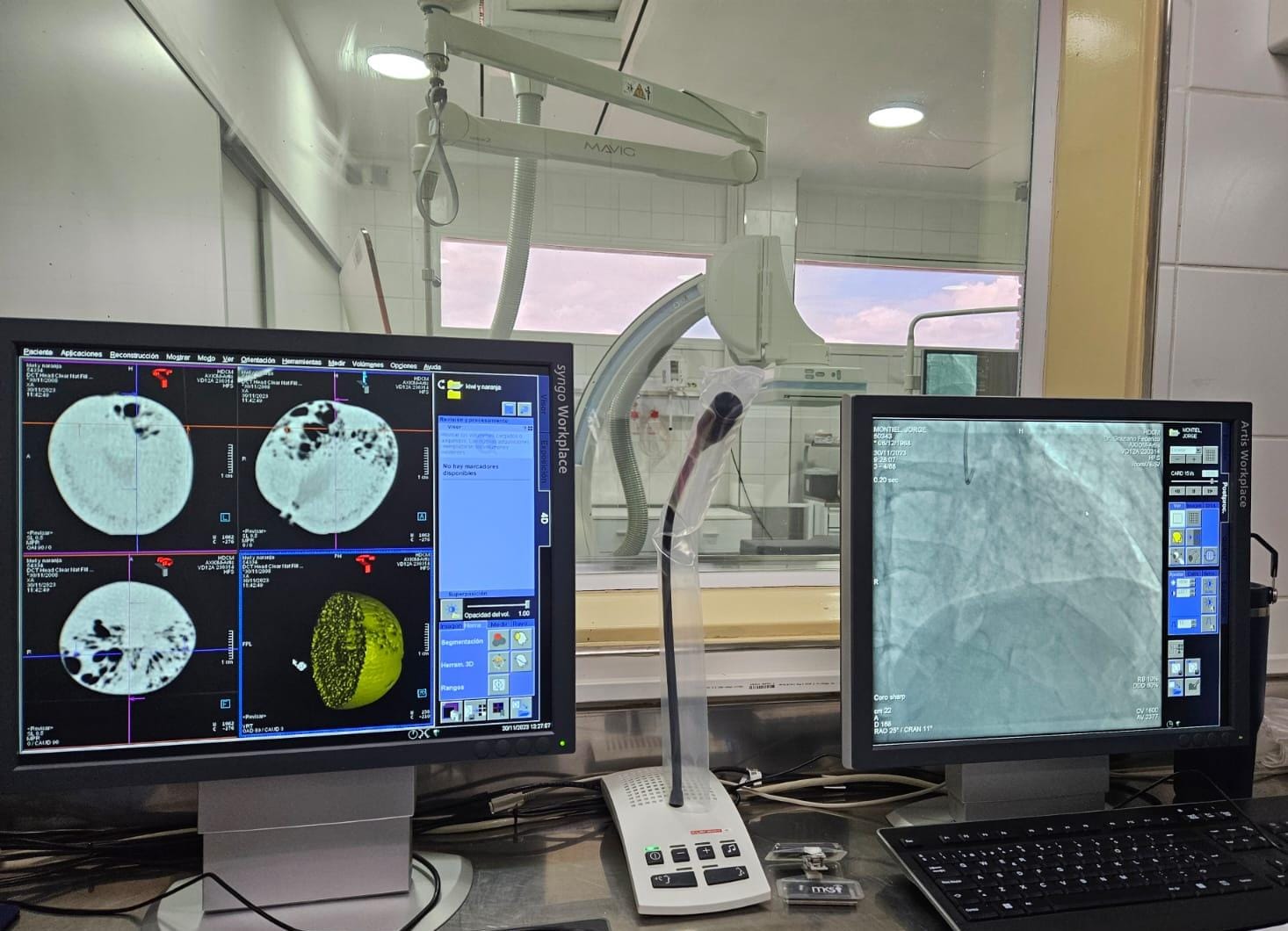 Hospital Masvernat alcanza las 100 intervenciones de Hemodinamia y Cardiología con el angiógrafo donado por CTM