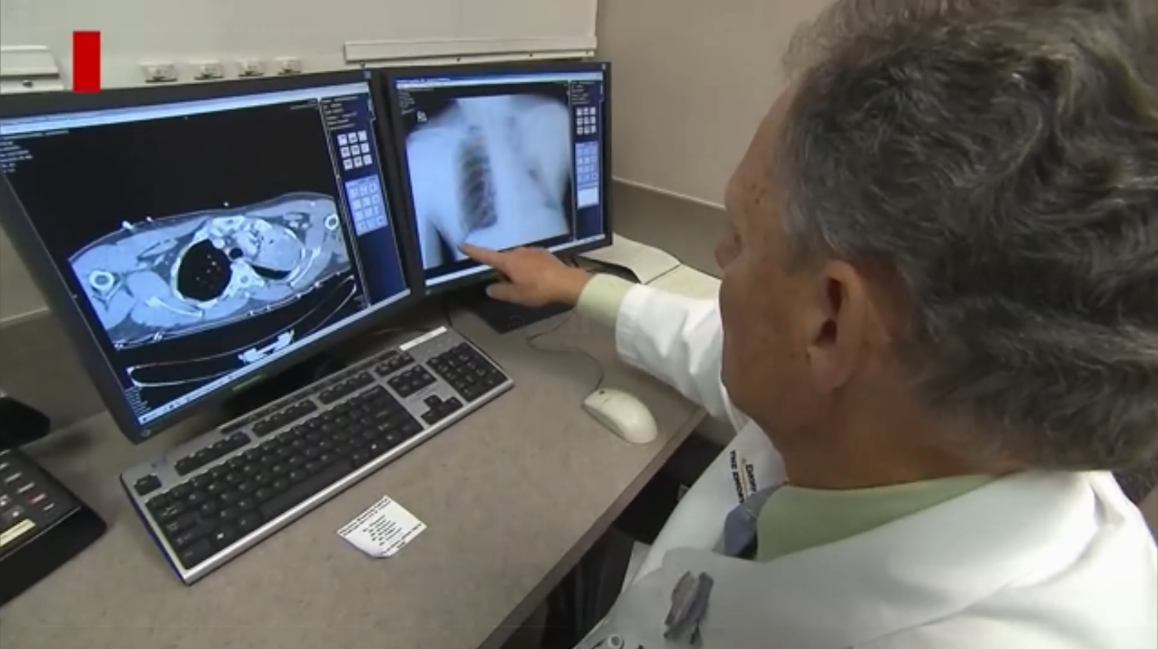 Así es la prueba recomendada de detección temprana de cáncer de pulmón