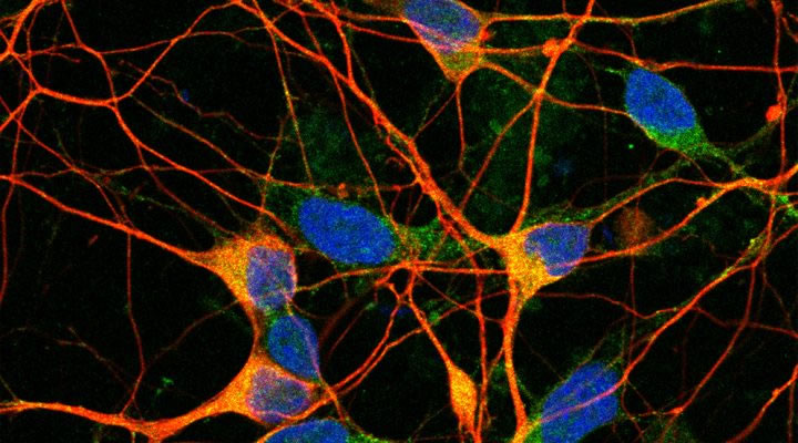 CONICET recibe apoyo global para desarrollar tratamientos innovadores contra el Alzheimer