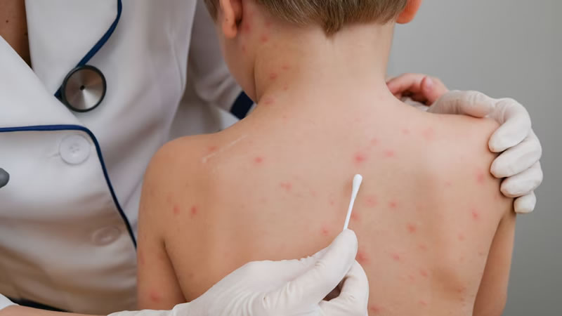 Se confirmó un nuevo caso de sarampión y hay alerta epidemiológica