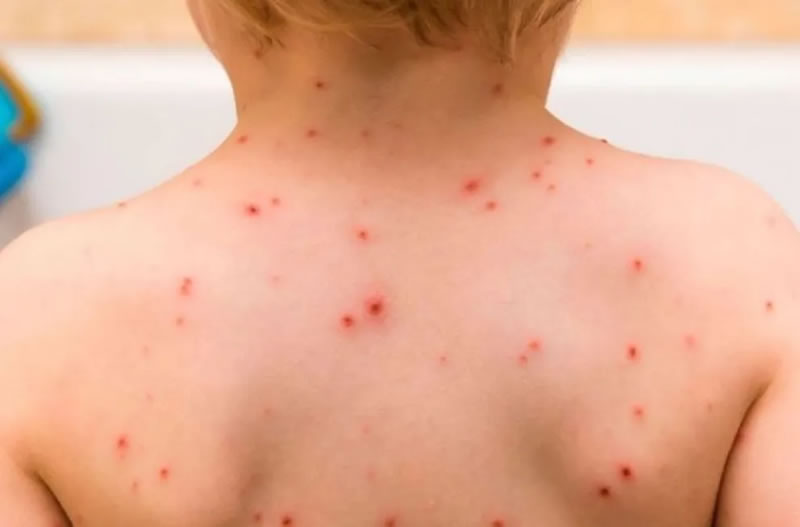 Alerta por rebrote de varicela en Gualeguaychú: refuerzan las medidas de prevención