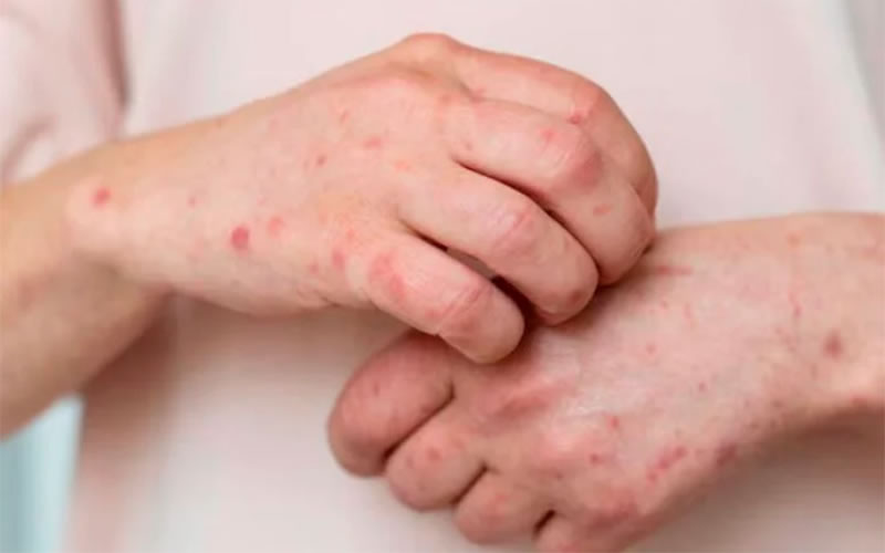 Sífilis en Argentina: las cifras baten récords y preocupa una epidemia invisible