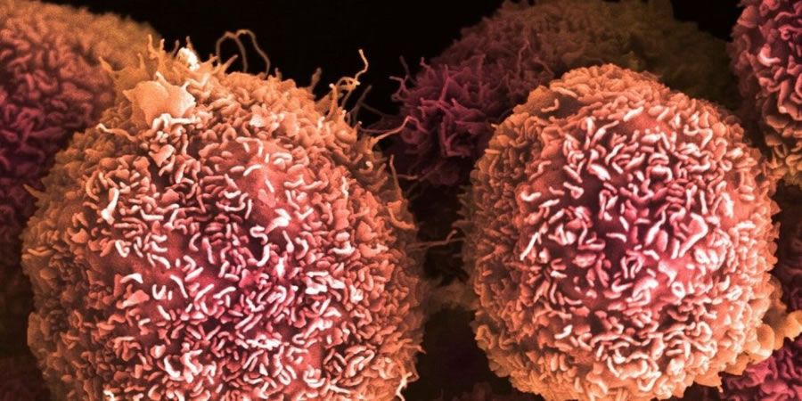 Un fármaco experimental marcó un avance histórico contra el cáncer de páncreas