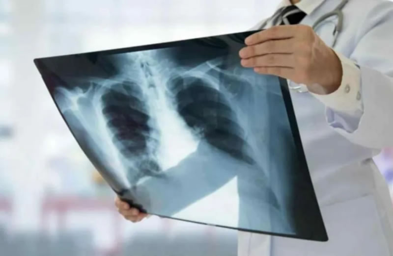 Los casos de tuberculosis aumentaron en Entre Ríos casi un 39% en lo que va de 2026