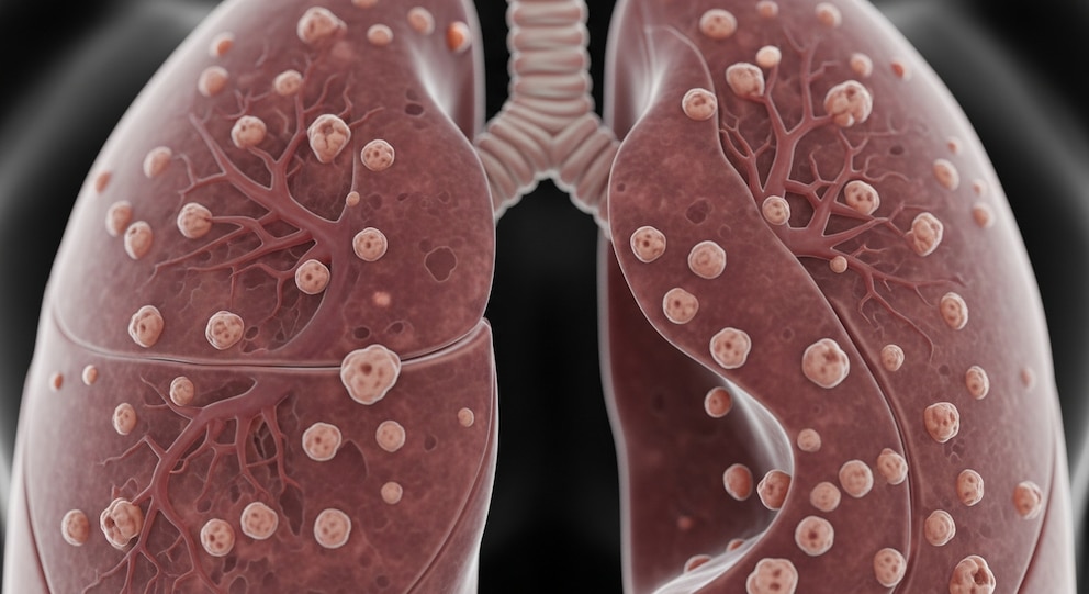 Aumento de casos de tuberculosis en Argentina: qué dicen los últimos datos del Ministerio de Salud