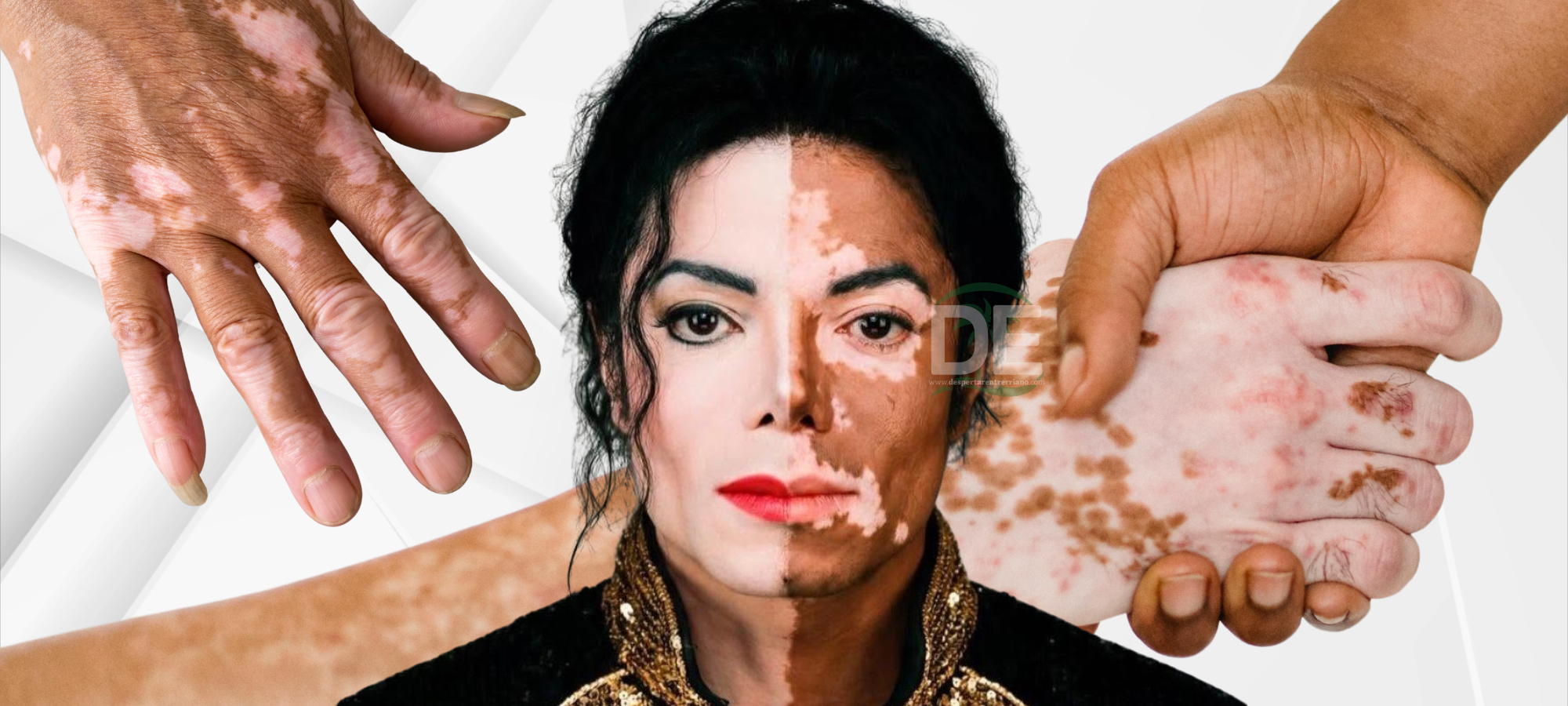 Día Mundial del Vitiligo